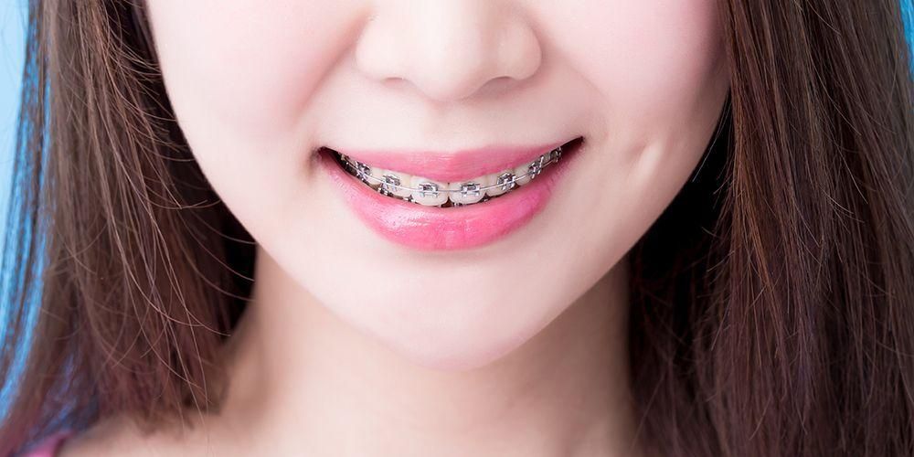 これは、最大のきちんとした歯のための正しいブレース治療です
