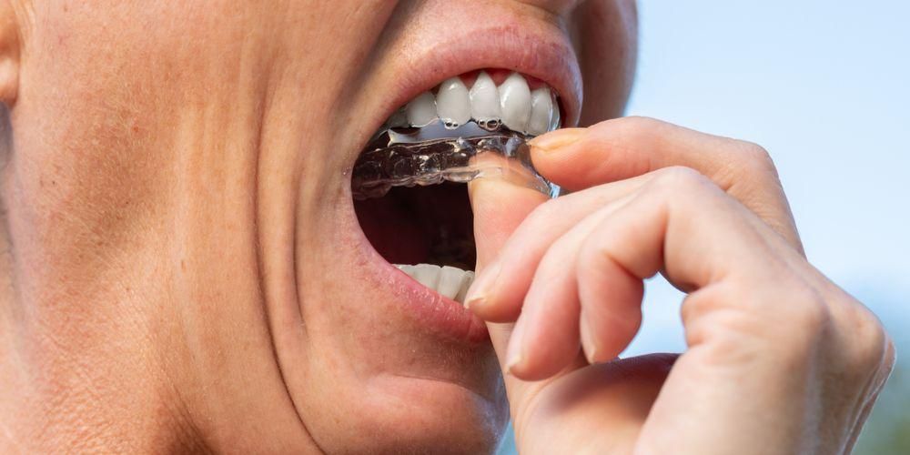Come raddrizzare i denti senza apparecchio, utilizzare i fermi per gli allineatori