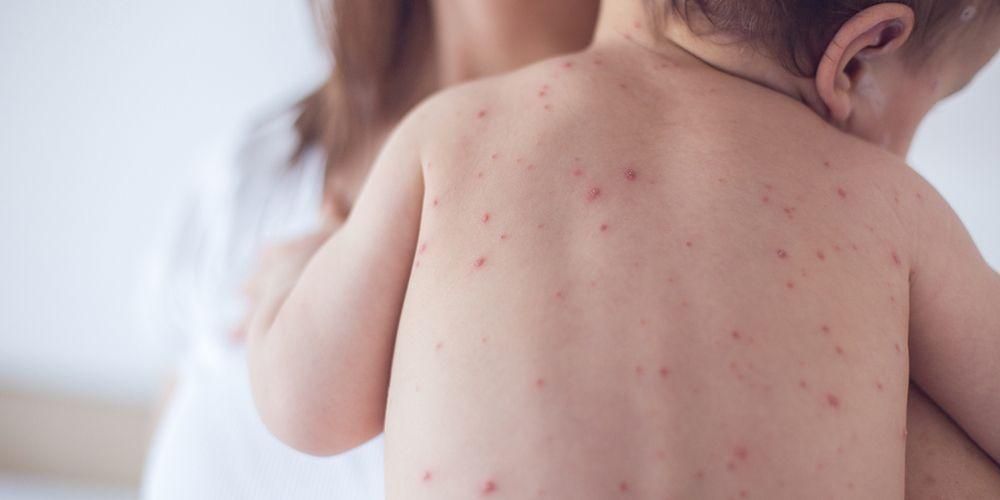 起こりうる子供の皮膚病の10種類