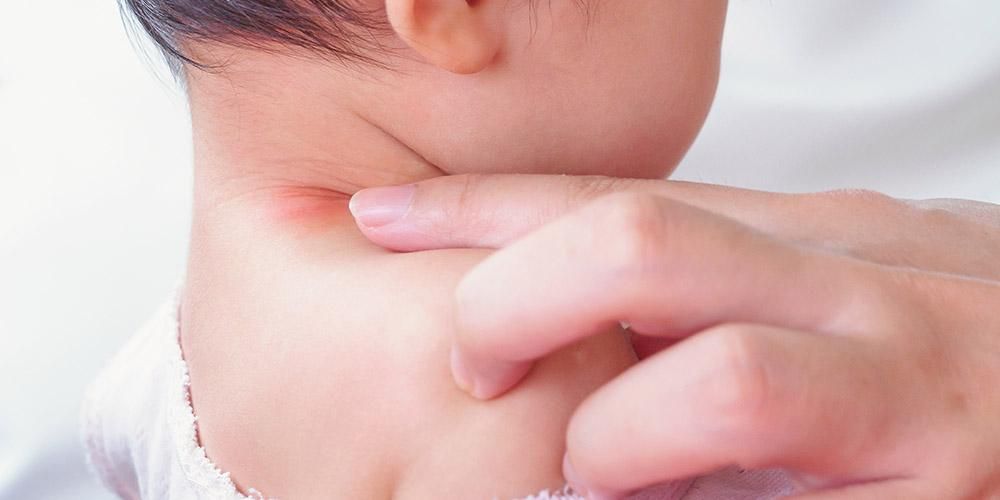 6 اسباب ظهور بقع حمراء على بشرة الاطفال بدون حمى وعلاجها