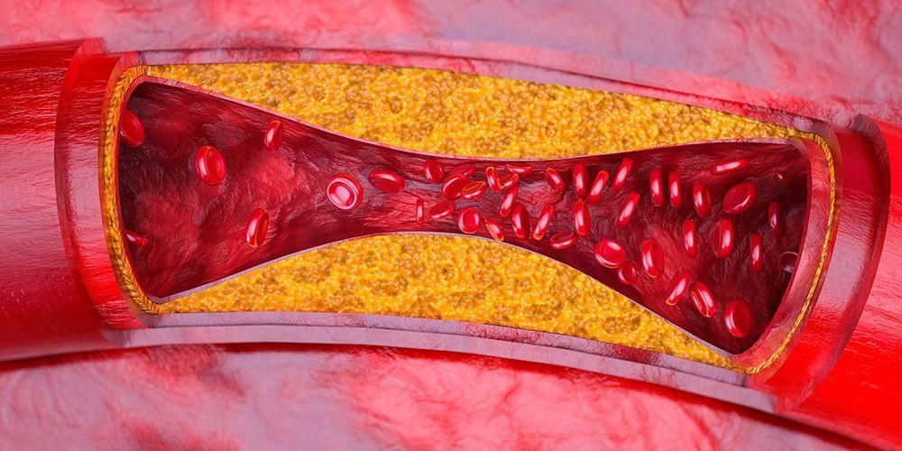 Това са 10 неща, които причиняват стесняване на кръвоносните съдове
