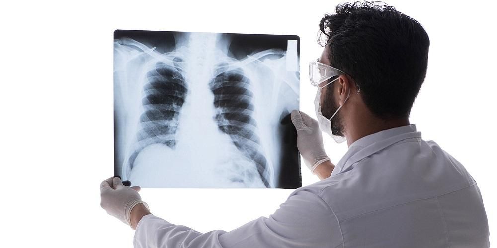 Това е снимка на белите дробове на пациент с корона, знак за тежка инфекция с Covid-19