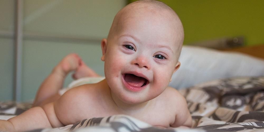 Bayi Sindrom Down, Kenali Karakteristik dan Cara Merawatnya