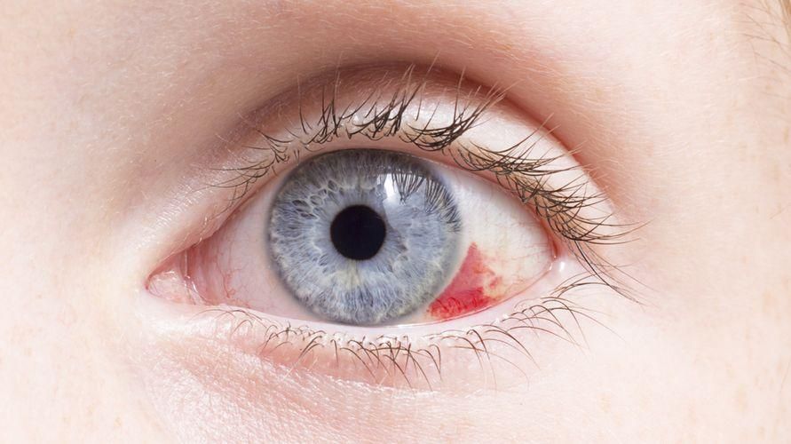10 أسباب لكسر أوعية دموية للعين يجب مراقبتها