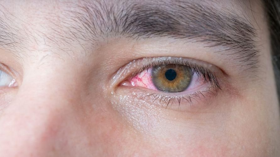 Причини за червени вени в очите и как да ги преодолеем