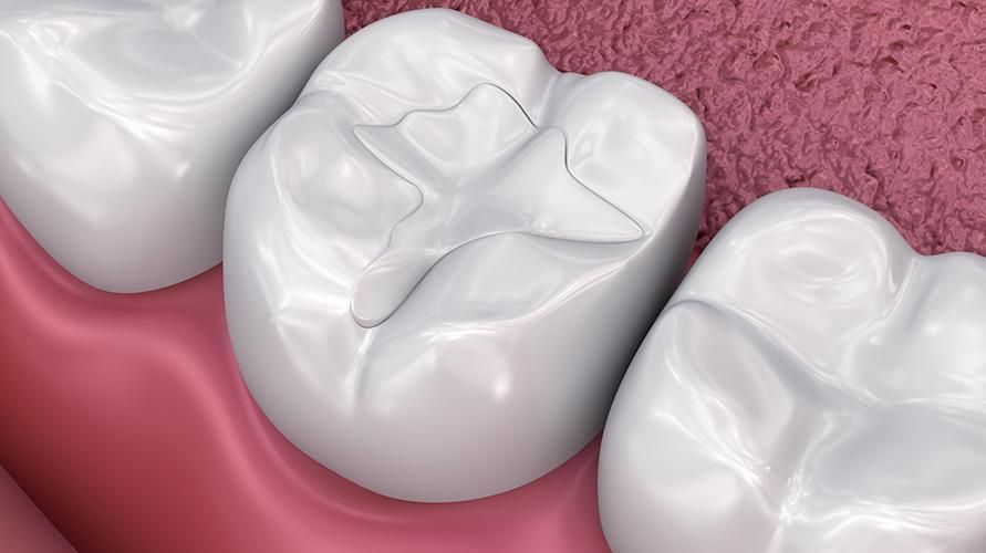 一時的な歯科用充填物と永久的な歯科用充填物のどちらが良いですか？