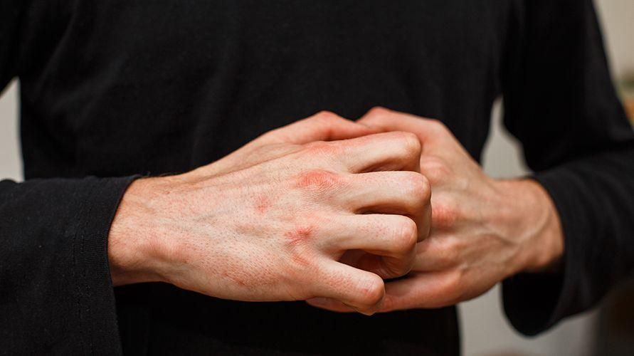 かゆみを伴う指と水っぽいシミ：原因と治療方法