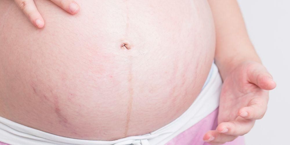 妊娠中のストレッチマークの原因とそれらを克服する方法