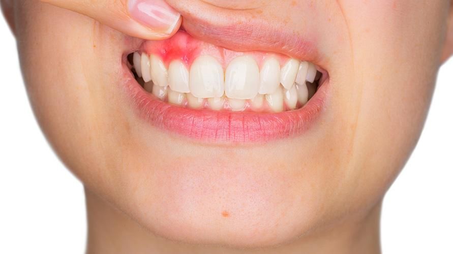 Enfeksiyonun yayılmasını önlemek için önemli olan şişmiş diş etleri için antibiyotikler