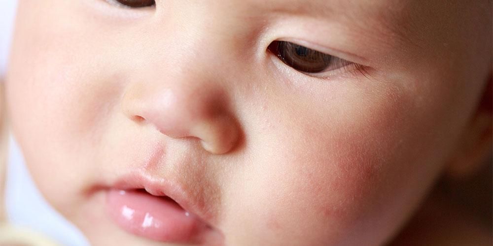 Бели петна по лицето на бебето като Пану, симптоми на питириазис алба