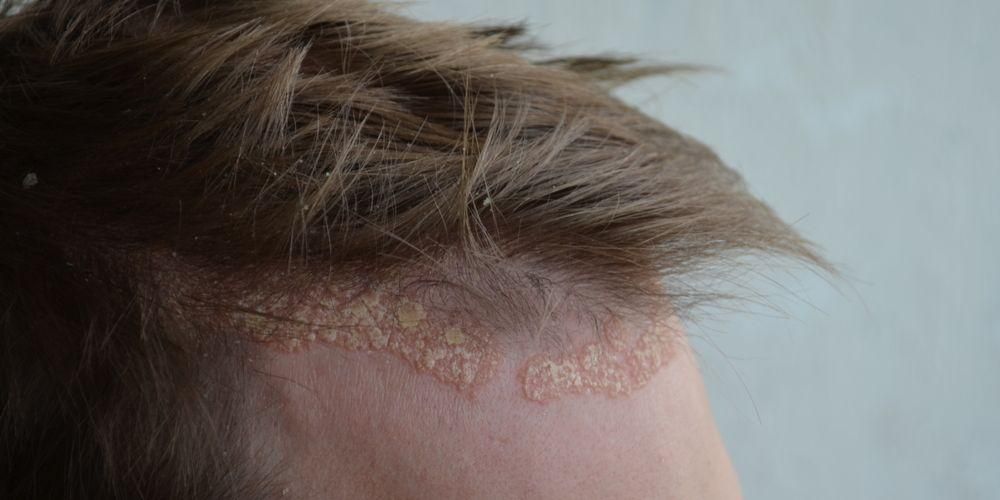 頭皮乾癬、その原因、症状、および治療
