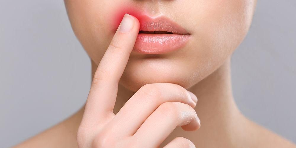 Това са причините за акне по устните и как да ги лекуваме правилно