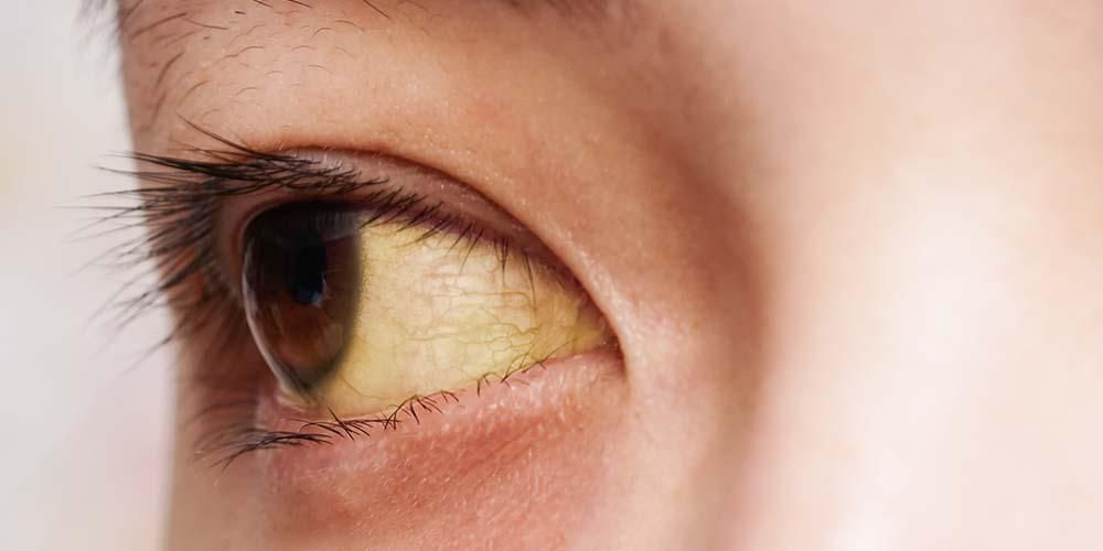 أسباب اصفرار العين واضطرابات الكبد لتفاعلات نقل الدم