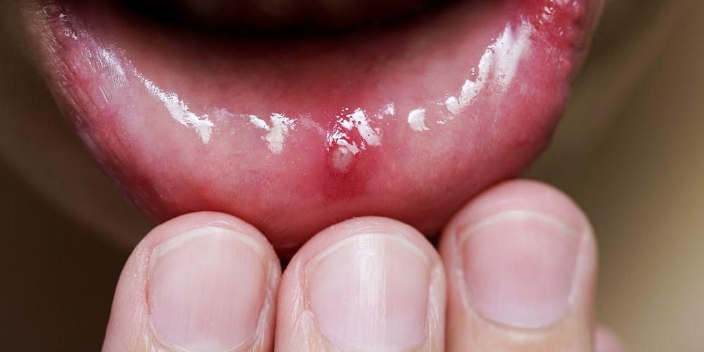 口内炎が天然成分で刺されないように口内炎を治療する方法