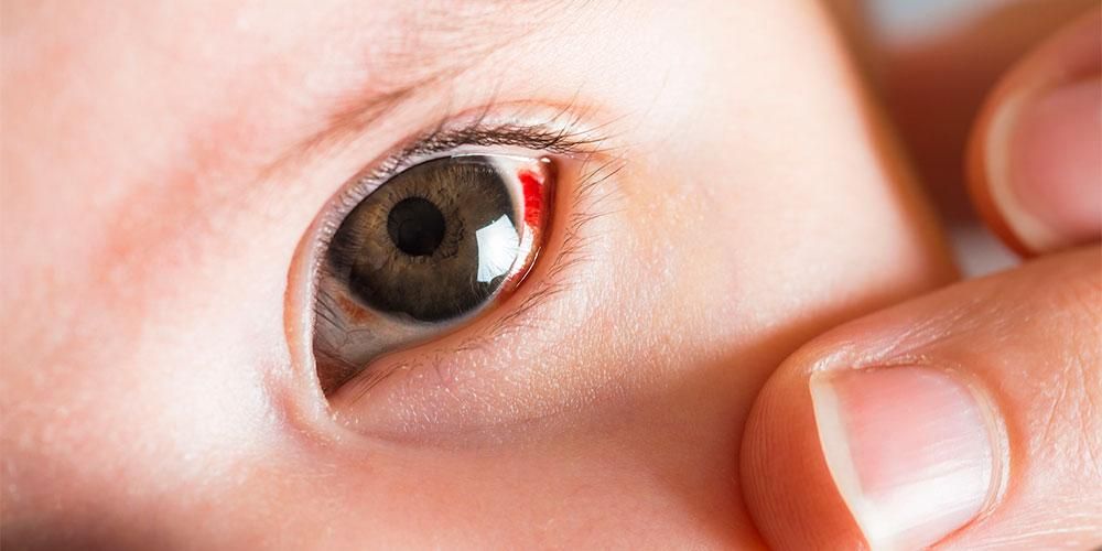 Kırmızı Bebek Gözlerinin Çeşitli Nedenleri ve Nasıl Üstesinden gelinir?