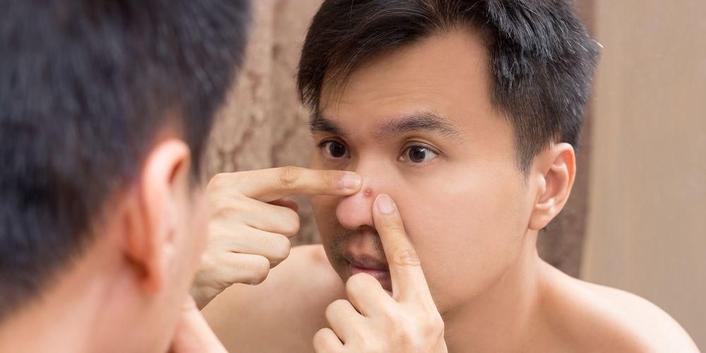 Акнето по носа, какво го причинява и как да се лекува?