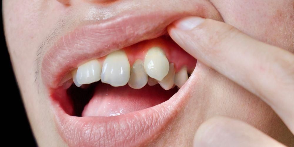 Запознаване с кривите ви зъби и най -добрият начин да ги изправите
