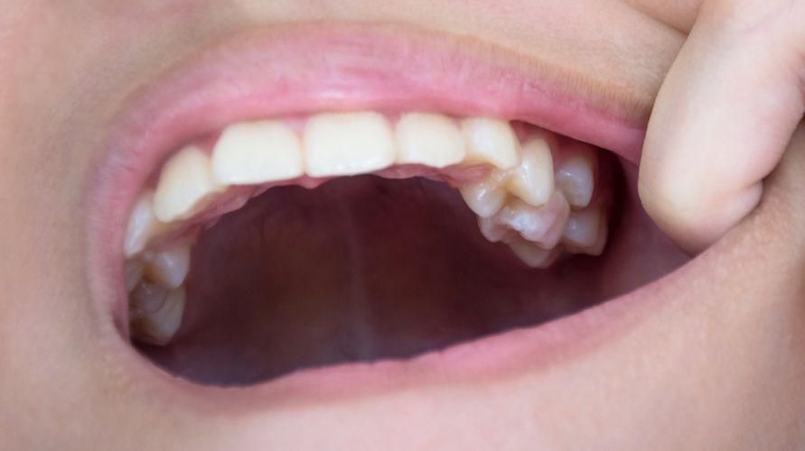 Натрупаните зъби при децата трябва да бъдат лекувани незабавно, ето причината