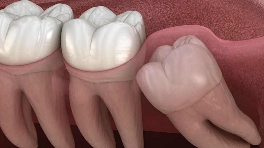 สาเหตุของฟันคุดขึ้นเฉียง และเวลาที่ดีที่สุดสำหรับการผ่าตัด