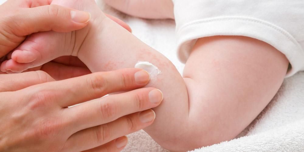 赤ちゃんのためのかゆみ軟膏、安全な推奨事項は何ですか？