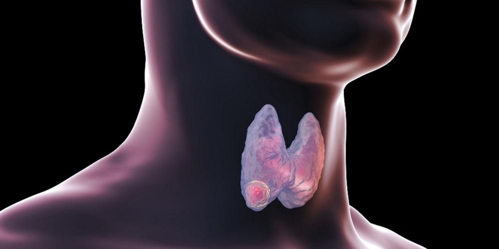 Kelebihan dan kekurangan hormon tiroid boleh mencetuskan pelbagai penyakit