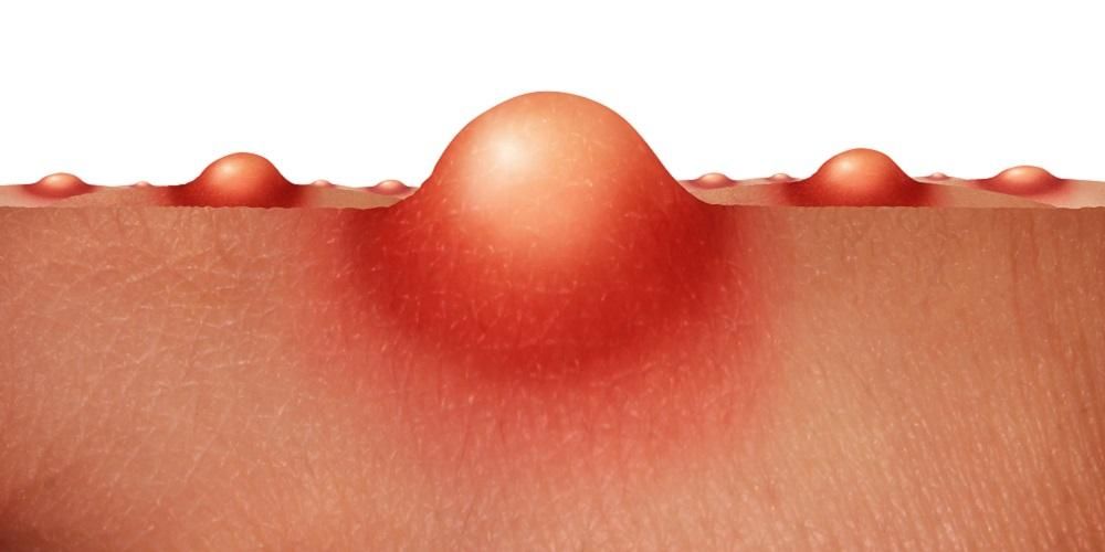 Често се появява по венците и кожата, какво е абсцес?
