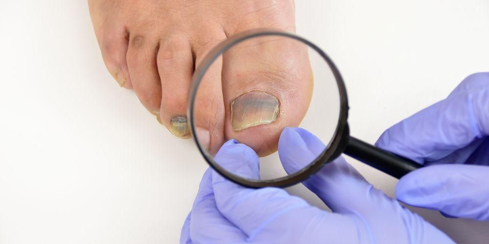 7 причини за черни нокти на краката, които трябва да знаете