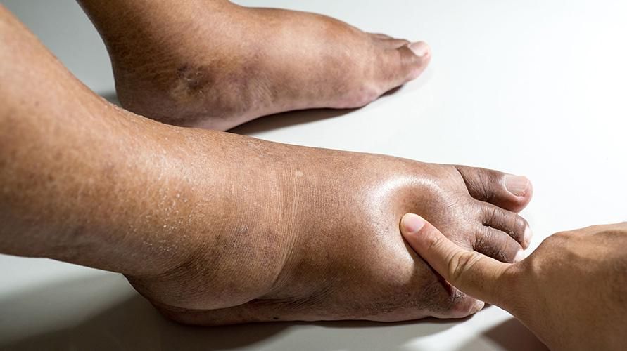Подути крака до нервни разстройства, може ли да са симптоми на бери -бери?