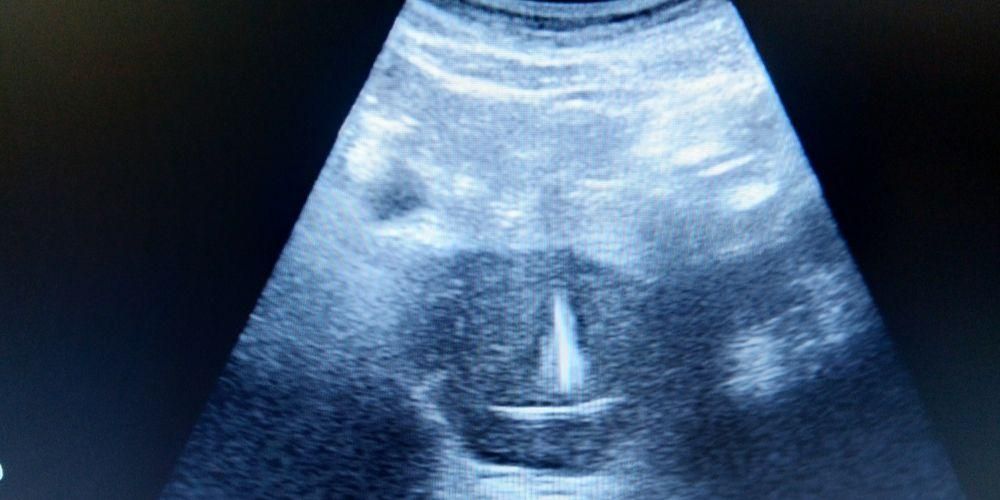 逆子宮は妊娠することができます、どうやって？