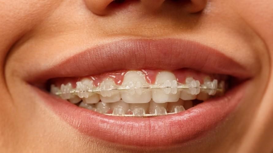Различни форми на зъби, които се нуждаят от скоби и алтернативни методи