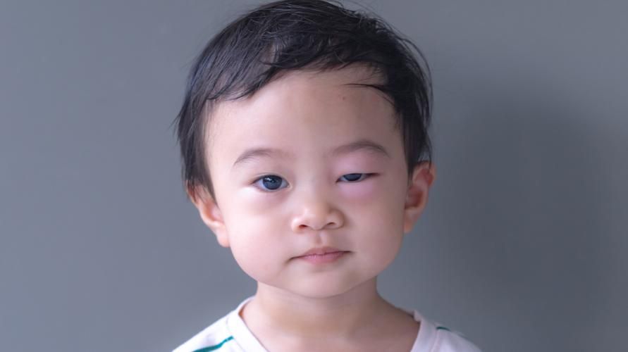 7 причини за подуване на очите при деца и ефективни решения