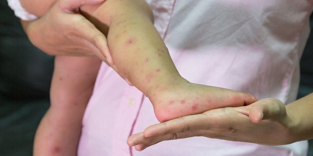 赤ちゃんの水痘の症状、適切な予防のための治療