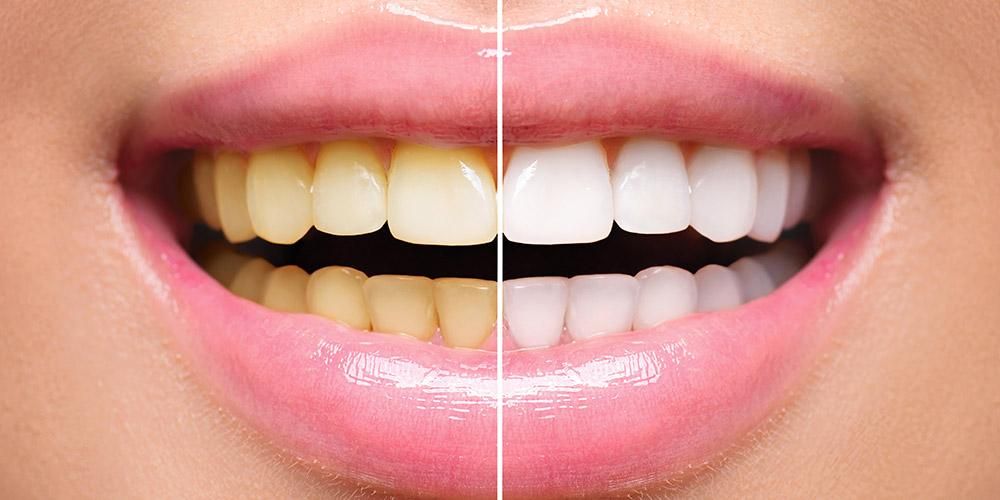 Sarı Dişlerin Nedenlerini ve Nasıl Üstesinden gelineceğini bilin