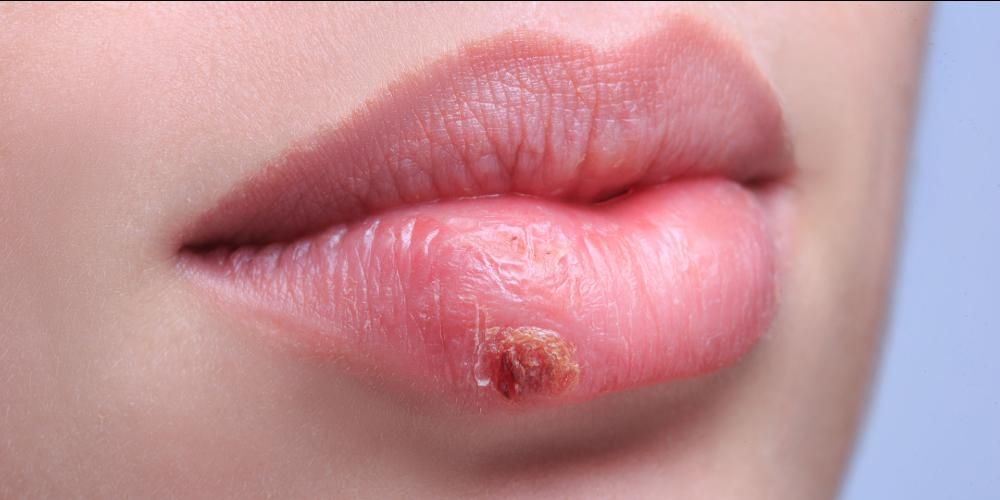 Червени рани около устата, може ли да е херпес лабиалис?