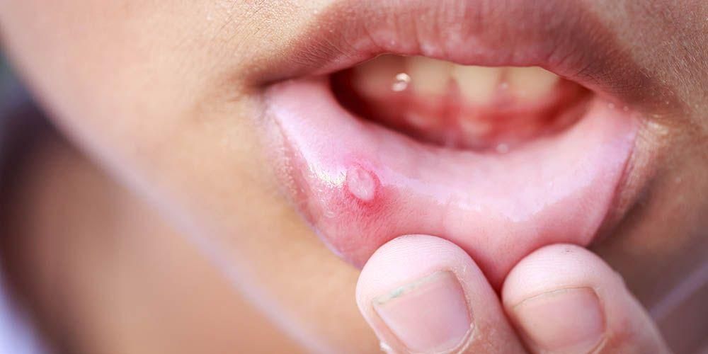 Мукоцеле, причината за рядко известни удари по устните