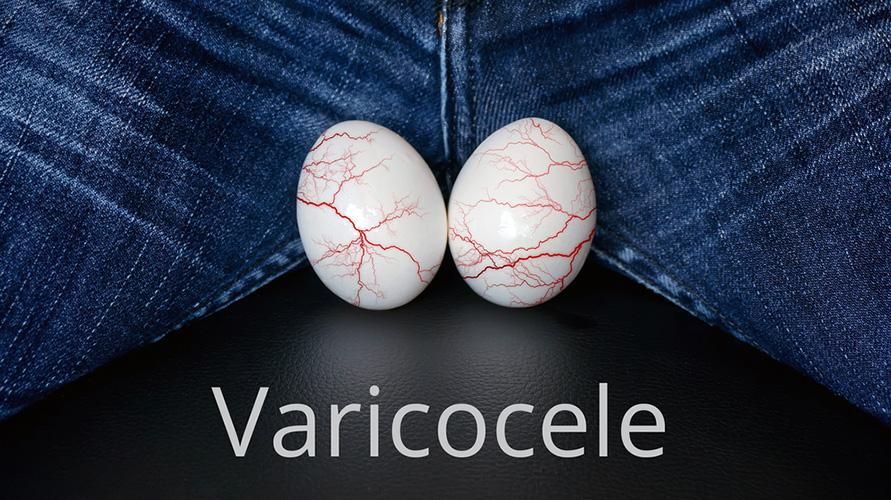เปิดเผยประโยชน์ของยาสมุนไพร Varicocele ได้ผลหรือไม่?