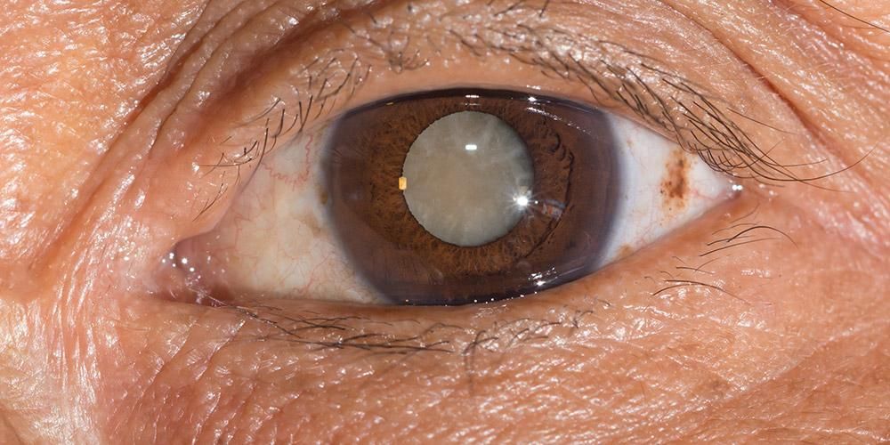 تعرف على خصائص إعتام عدسة العين التالي لتجنب الإصابة بالعمى