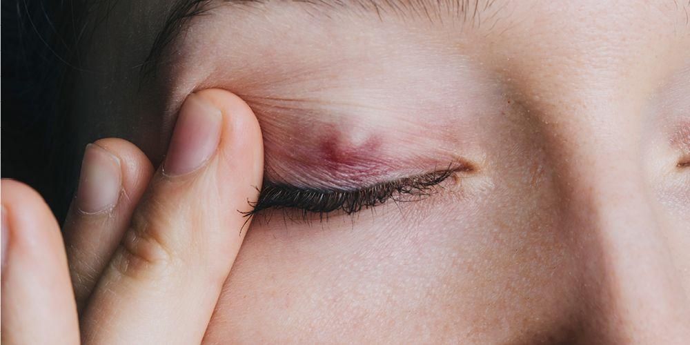 سلسلة من علاجات Stye Eye القوية بالإضافة إلى كيفية منعها من العودة