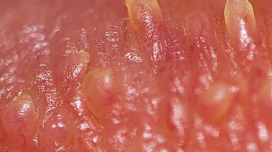 Piccoli grumi compaiono sui genitali maschili, potrebbe essere una papula perlacea del pene