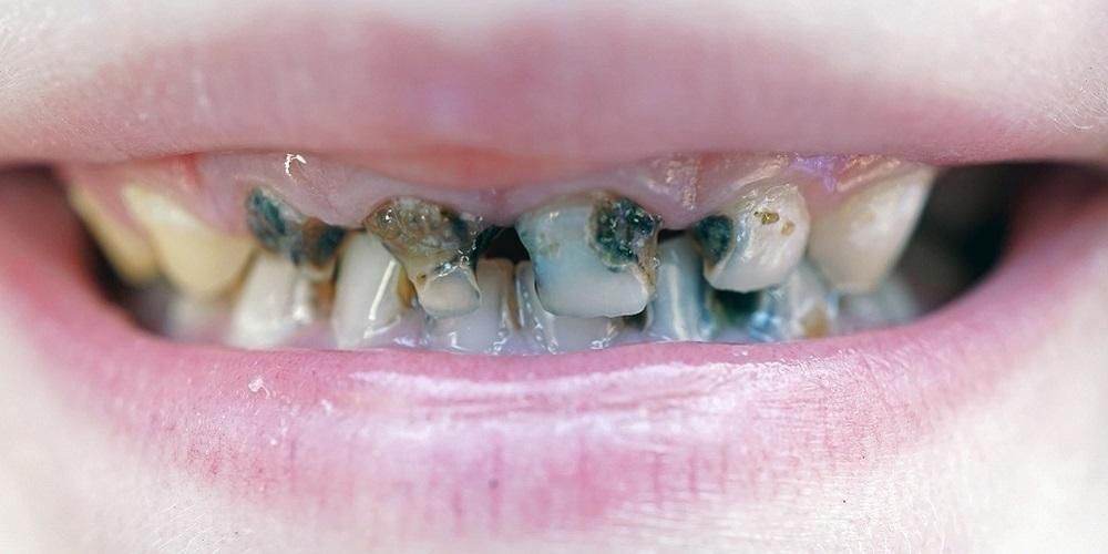 Cacing gigi Menyebabkan Sakit Gigi dan Rongga, Mitos atau Fakta?