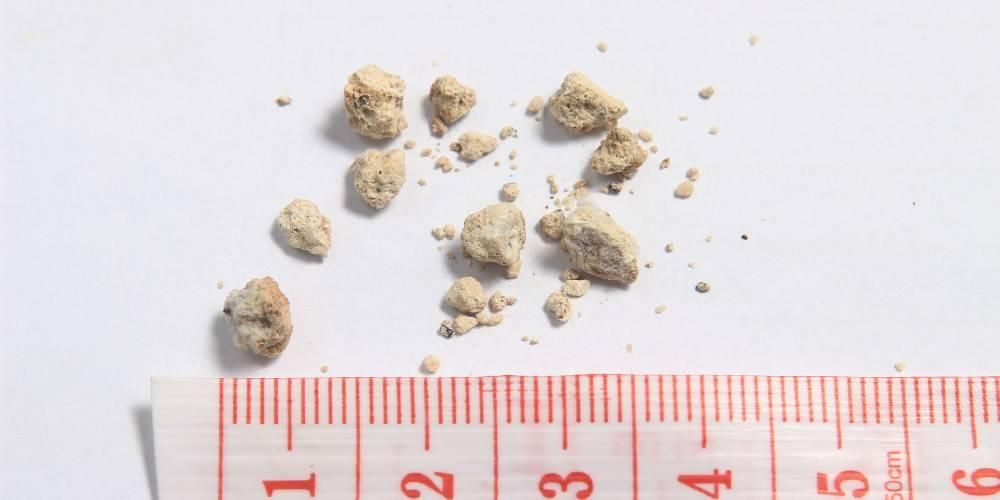 シュウ酸カルシウム結晶、最も一般的なタイプの腎臓結石