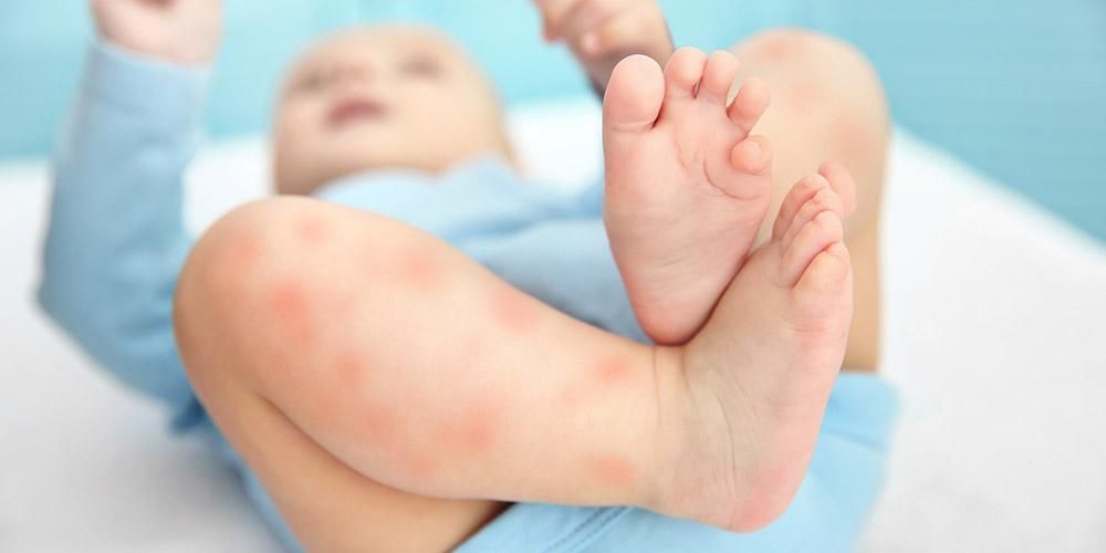 Видове кожни алергии при бебета, какви са причините и как да се предотврати?