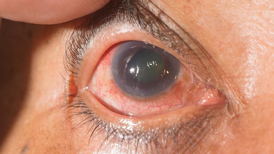 Bolehkah Penyembuhan Glaukoma? Ketahui Fakta Sebenar