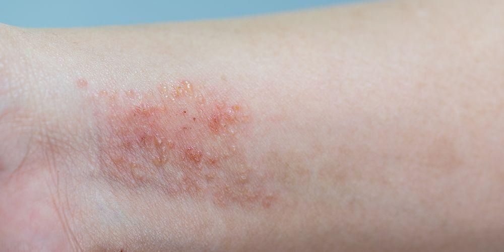 Evita questo in modo che la pelle secca e pruriginosa a causa dell'eczema non faccia più male