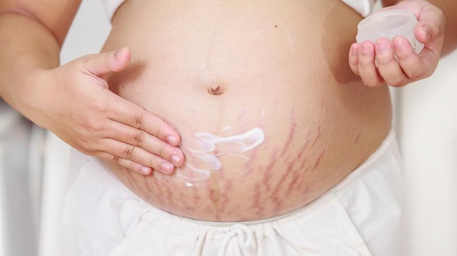 9 วิธีในการกำจัดรอยแตกลายในระหว่างตั้งครรภ์ รู้วิธีป้องกันด้วย