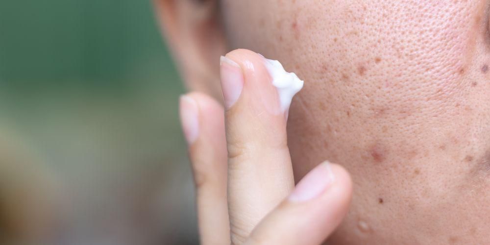 Come sbarazzarsi della fastidiosa acne cistica in modo sicuro ed efficace