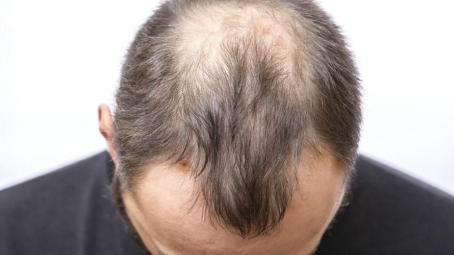 L'alopecia provoca la calvizie nei capelli, possono ricrescere?