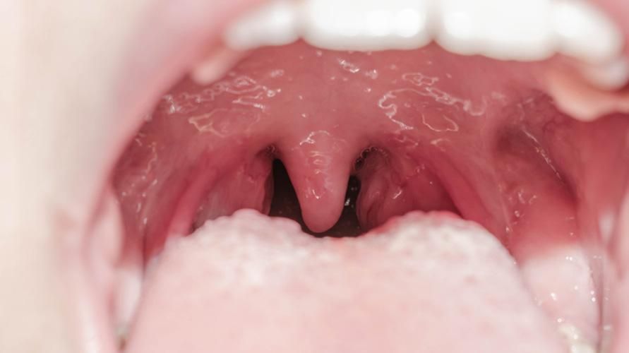 Conoscere la funzione delle tonsille e le malattie che le interferiscono