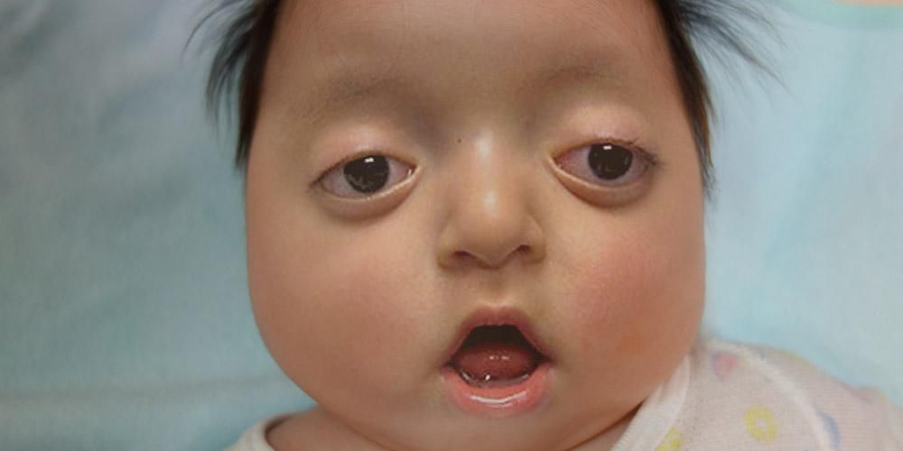 Kenali Pfeiffer Syndrome, keadaan yang menyebabkan kelainan wajah pada bayi