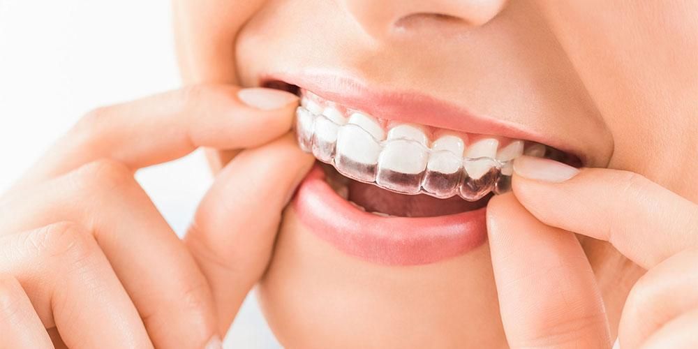 اجعل ابتسامتك أكثر جاذبية ، كيف تعمل حشوة الأسنان؟